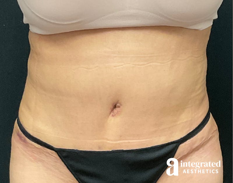 Tummy Tuck Before & After Gallery - Patient 133213527 - Image 2
