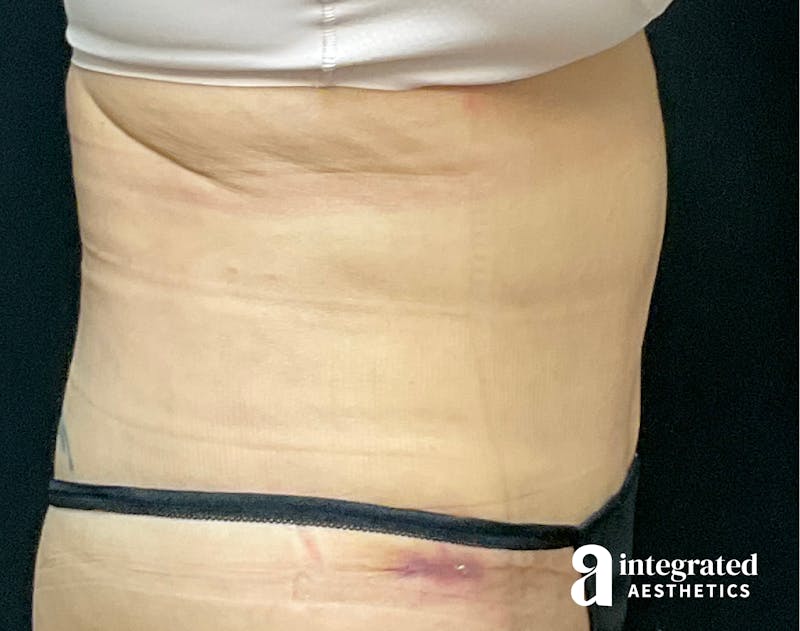 Tummy Tuck Before & After Gallery - Patient 133213527 - Image 8