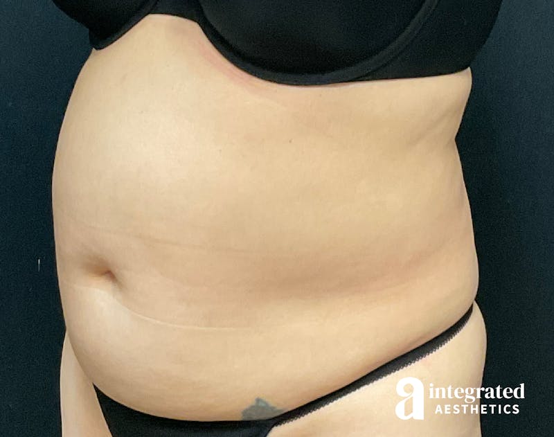 Tummy Tuck Before & After Gallery - Patient 133213527 - Image 3