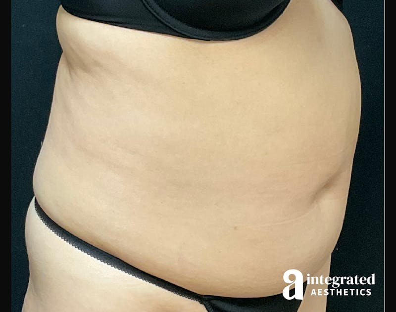 Tummy Tuck Before & After Gallery - Patient 133213527 - Image 5