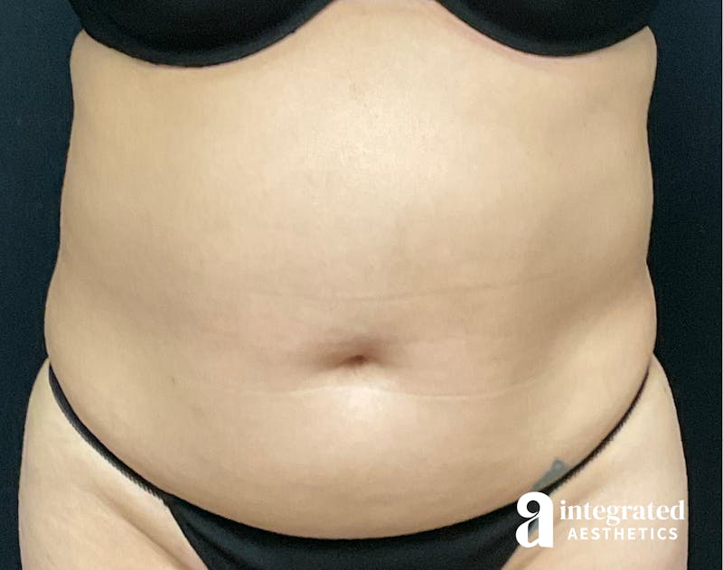 Tummy Tuck Before & After Gallery - Patient 133213527 - Image 1
