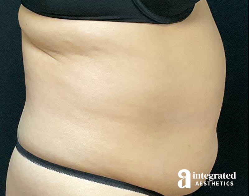Tummy Tuck Before & After Gallery - Patient 133213527 - Image 7