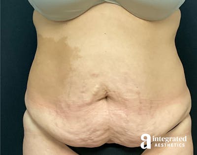 Tummy Tuck Before & After Gallery - Patient 133213534 - Image 1