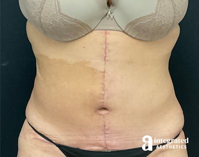 Tummy Tuck Before & After Gallery - Patient 133213534 - Image 2