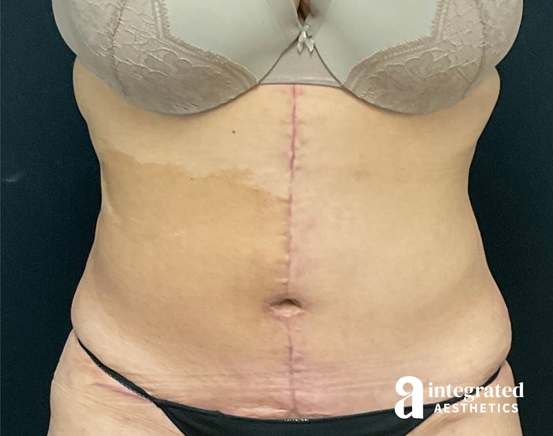 Tummy Tuck Before & After Gallery - Patient 133213534 - Image 2