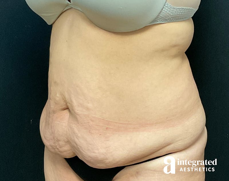 Tummy Tuck Before & After Gallery - Patient 133213534 - Image 3