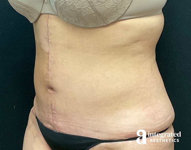 Tummy Tuck Before & After Gallery - Patient 133213534 - Image 4
