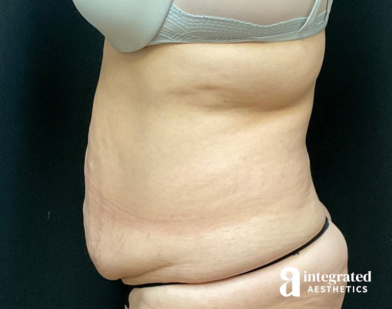 Tummy Tuck Before & After Gallery - Patient 133213534 - Image 5