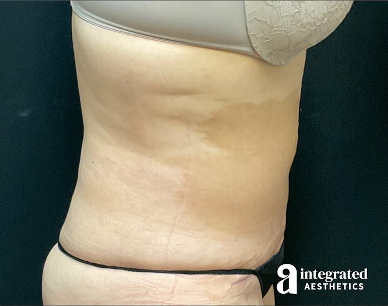 Tummy Tuck Before & After Gallery - Patient 133213534 - Image 8