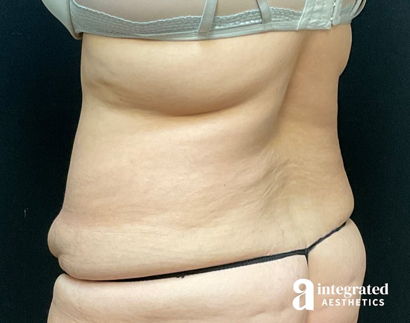 Tummy Tuck Before & After Gallery - Patient 133213534 - Image 9