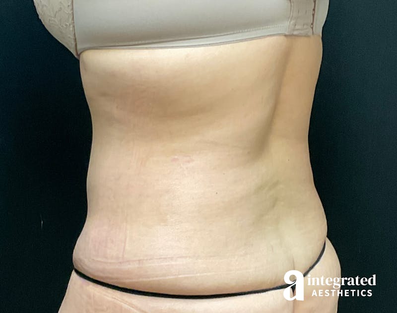 Tummy Tuck Before & After Gallery - Patient 133213534 - Image 10