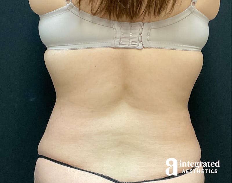 Tummy Tuck Before & After Gallery - Patient 133213534 - Image 12