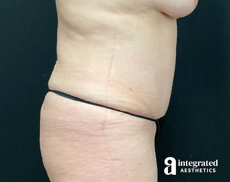 Tummy Tuck Before & After Gallery - Patient 133213543 - Image 10