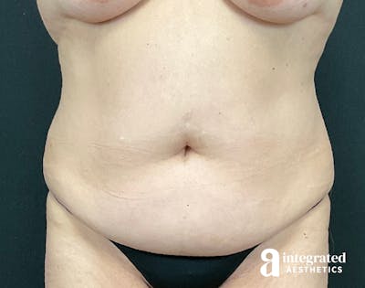 Tummy Tuck Before & After Gallery - Patient 133213543 - Image 1