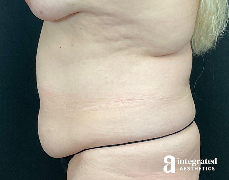 Tummy Tuck Before & After Gallery - Patient 133213543 - Image 7