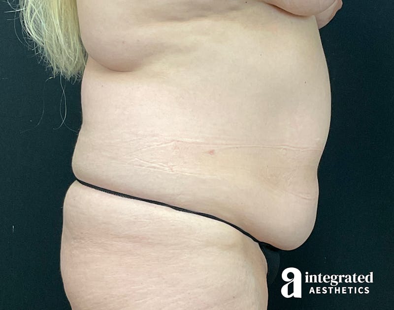 Tummy Tuck Before & After Gallery - Patient 133213543 - Image 9