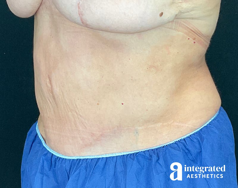 Tummy Tuck Before & After Gallery - Patient 133213561 - Image 4