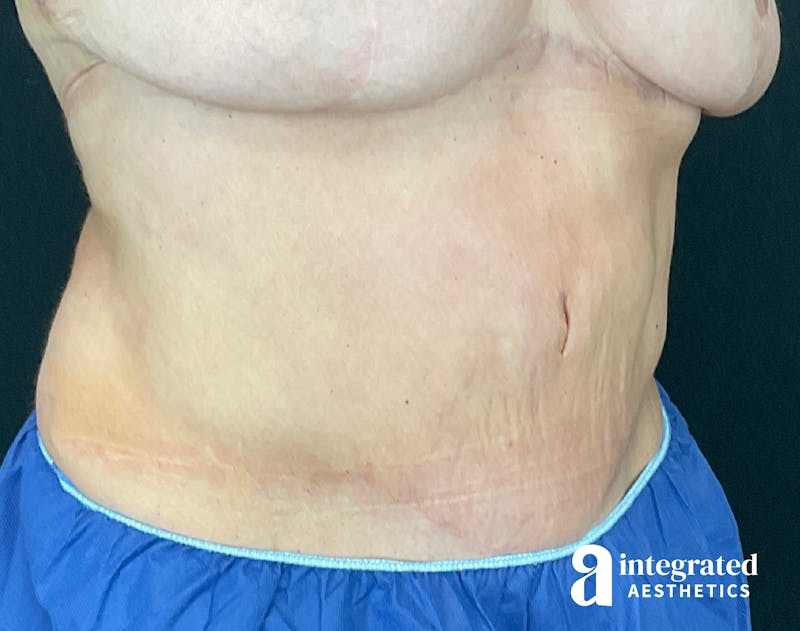 Tummy Tuck Before & After Gallery - Patient 133213561 - Image 6