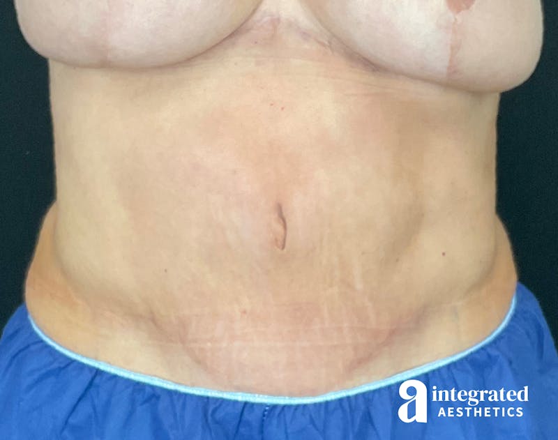 Tummy Tuck Before & After Gallery - Patient 133213561 - Image 2