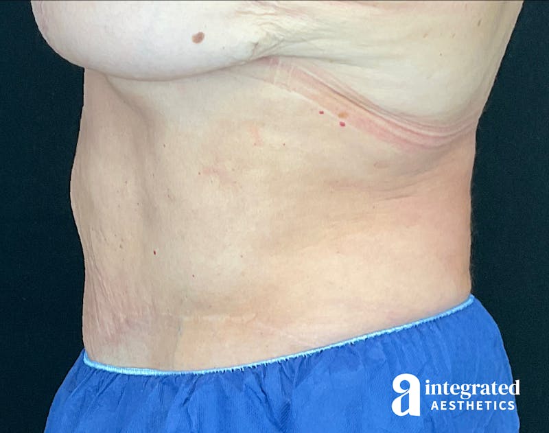 Tummy Tuck Before & After Gallery - Patient 133213561 - Image 8
