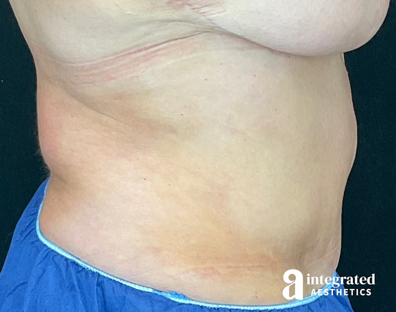 Tummy Tuck Before & After Gallery - Patient 133213561 - Image 10