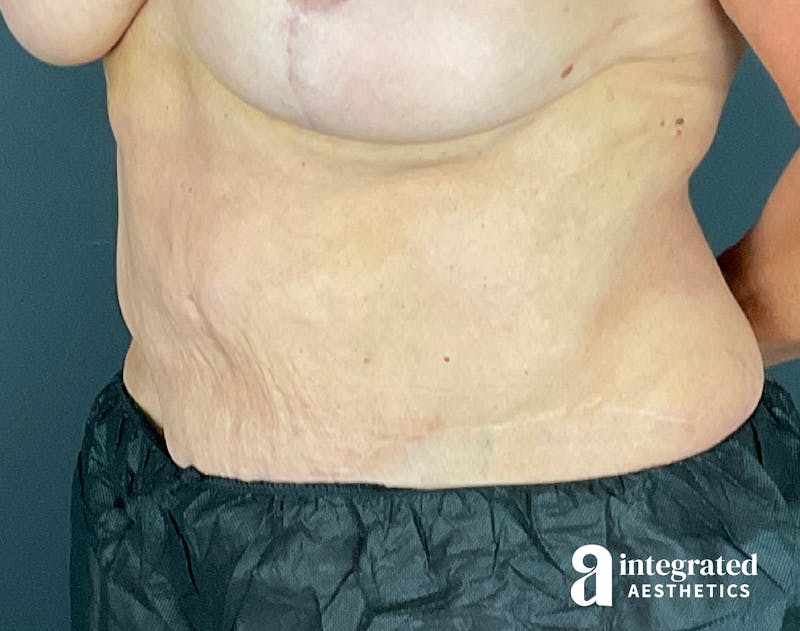 Tummy Tuck Before & After Gallery - Patient 133213561 - Image 3