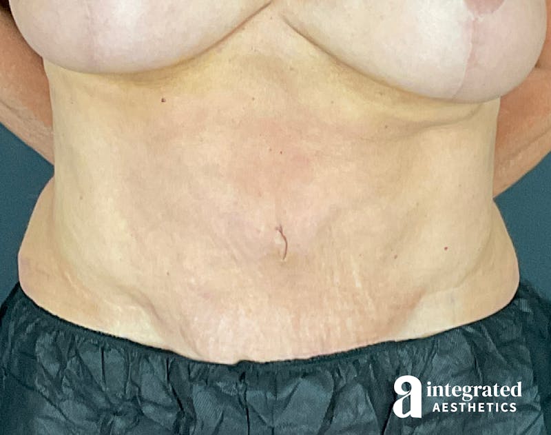 Tummy Tuck Before & After Gallery - Patient 133213561 - Image 1