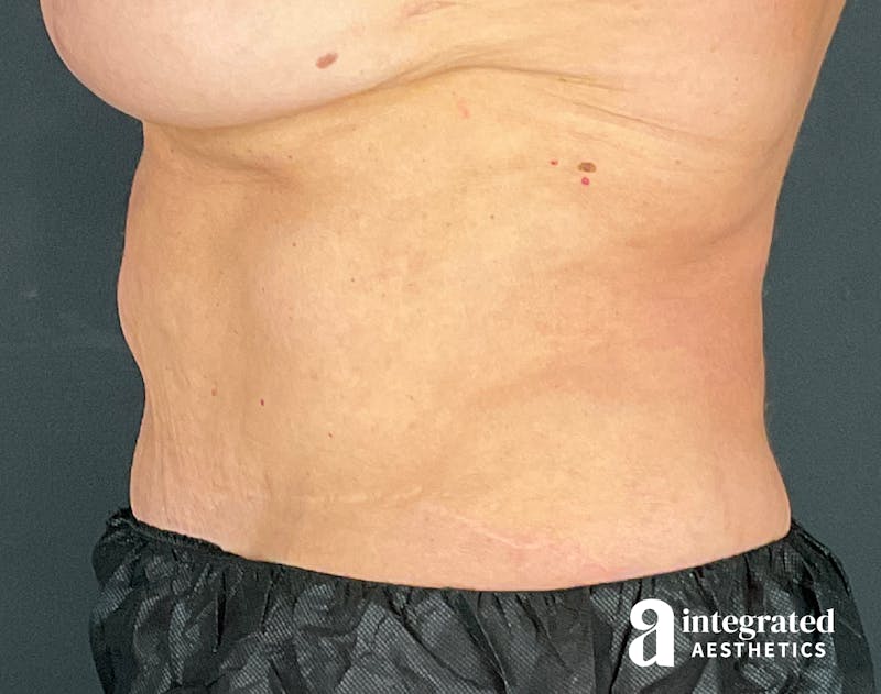 Tummy Tuck Before & After Gallery - Patient 133213561 - Image 7