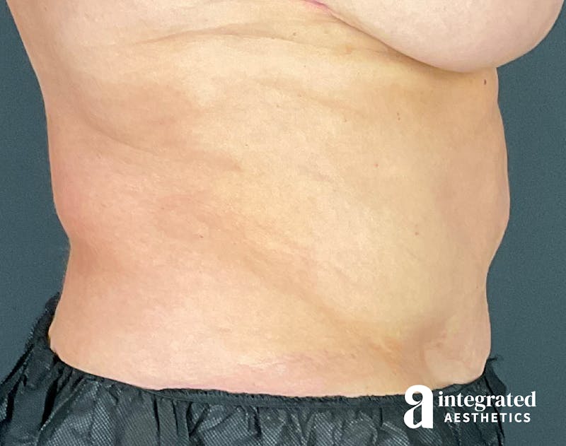 Tummy Tuck Before & After Gallery - Patient 133213561 - Image 9