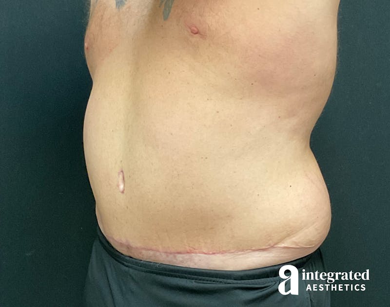 Tummy Tuck Before & After Gallery - Patient 133213612 - Image 4