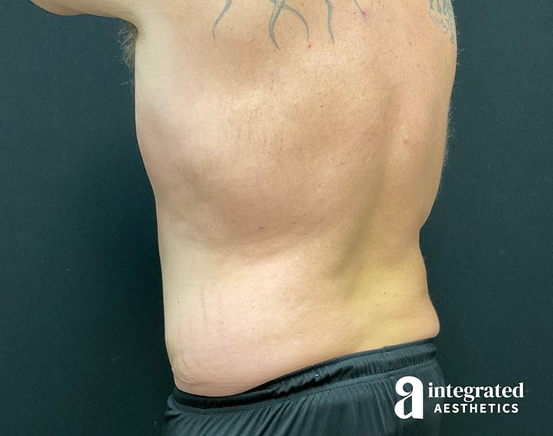 Tummy Tuck Before & After Gallery - Patient 133213612 - Image 8