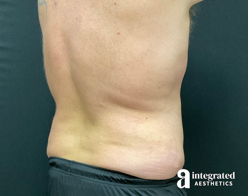 Tummy Tuck Before & After Gallery - Patient 133213612 - Image 10