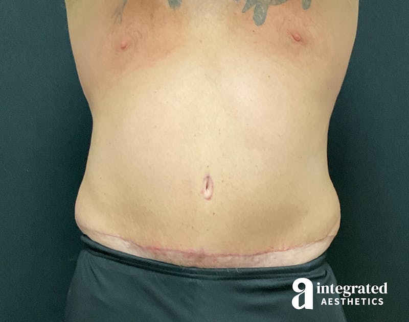 Tummy Tuck Before & After Gallery - Patient 133213612 - Image 2