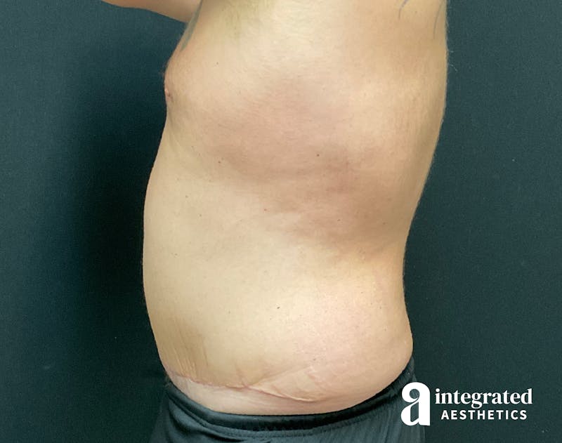 Tummy Tuck Before & After Gallery - Patient 133213612 - Image 12