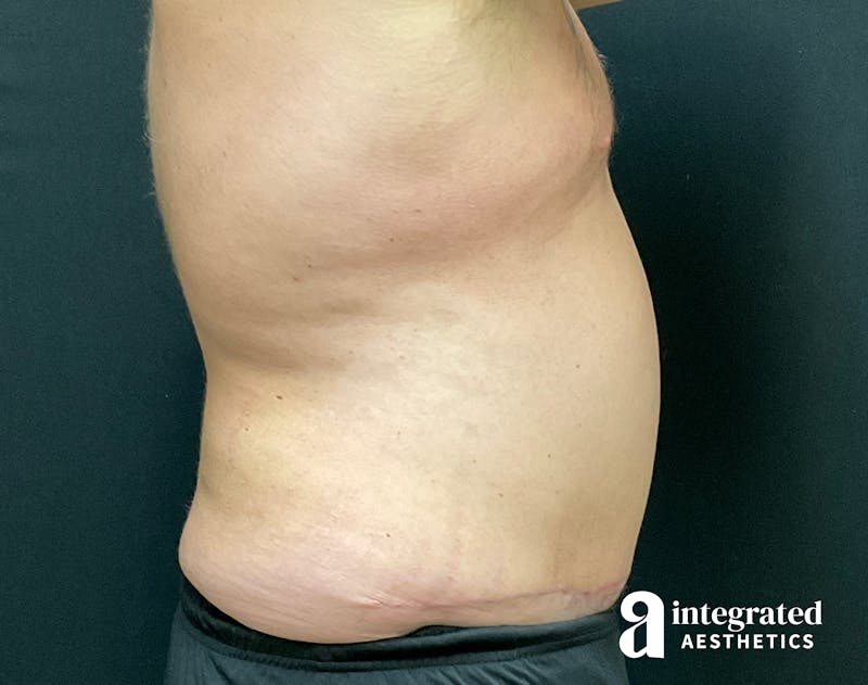 Tummy Tuck Before & After Gallery - Patient 133213612 - Image 14