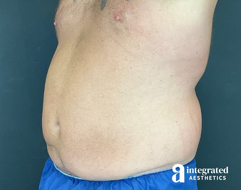 Tummy Tuck Before & After Gallery - Patient 133213612 - Image 3