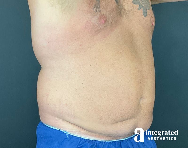 Tummy Tuck Before & After Gallery - Patient 133213612 - Image 5