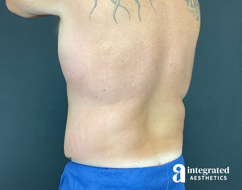 Tummy Tuck Before & After Gallery - Patient 133213612 - Image 7