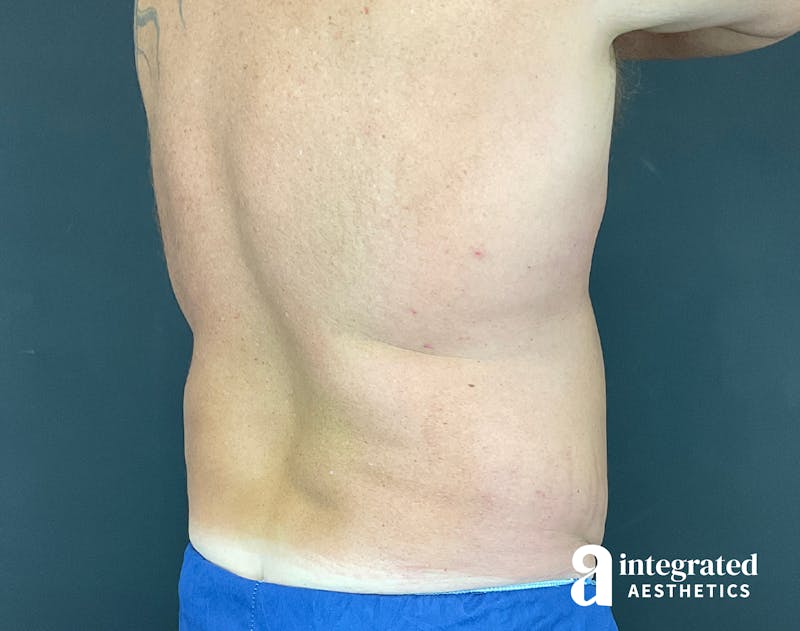 Tummy Tuck Before & After Gallery - Patient 133213612 - Image 9