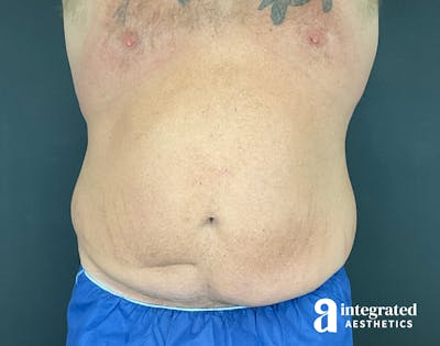 Tummy Tuck Before & After Gallery - Patient 133213612 - Image 1