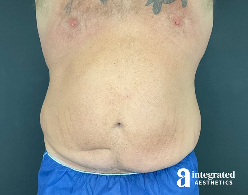 Tummy Tuck Before & After Gallery - Patient 133213612 - Image 1