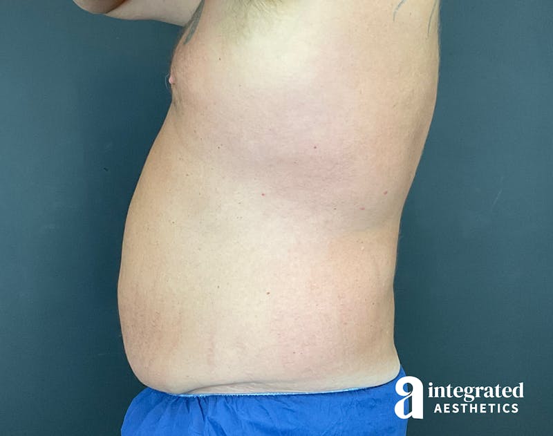 Tummy Tuck Before & After Gallery - Patient 133213612 - Image 11
