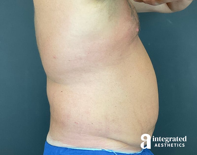 Tummy Tuck Before & After Gallery - Patient 133213612 - Image 13