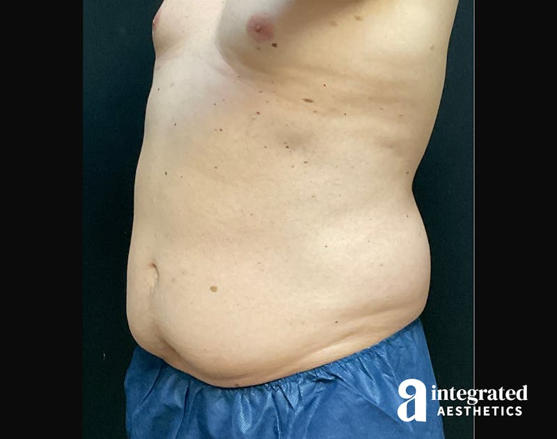 BodyTite Before & After Gallery - Patient 133213690 - Image 3