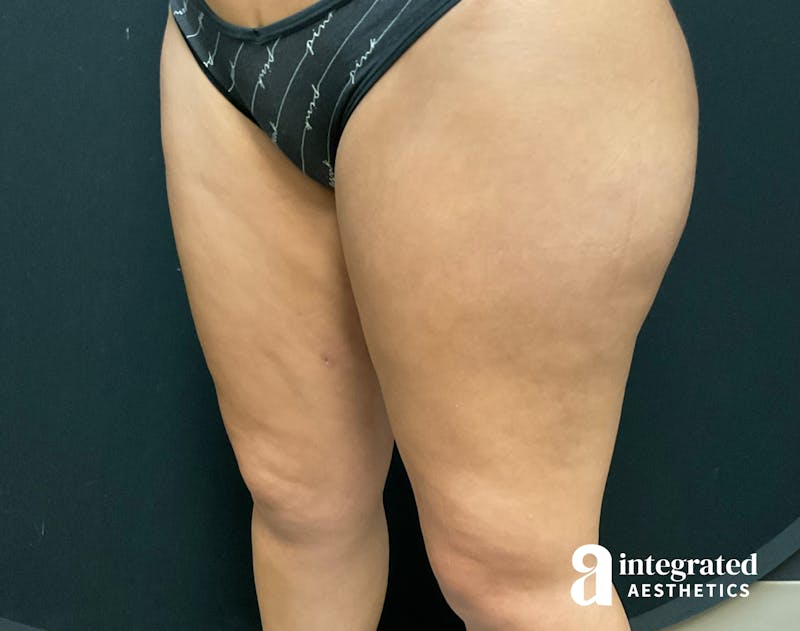 BodyTite Before & After Gallery - Patient 133213710 - Image 2
