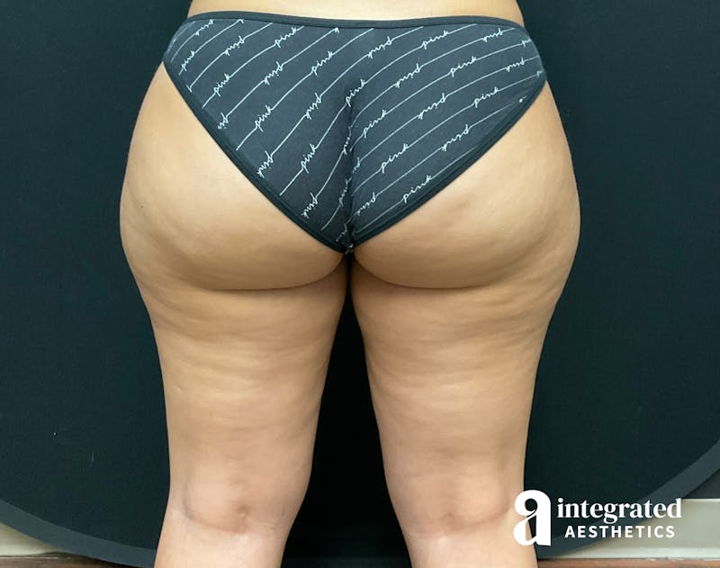 BodyTite Before & After Gallery - Patient 133213710 - Image 4