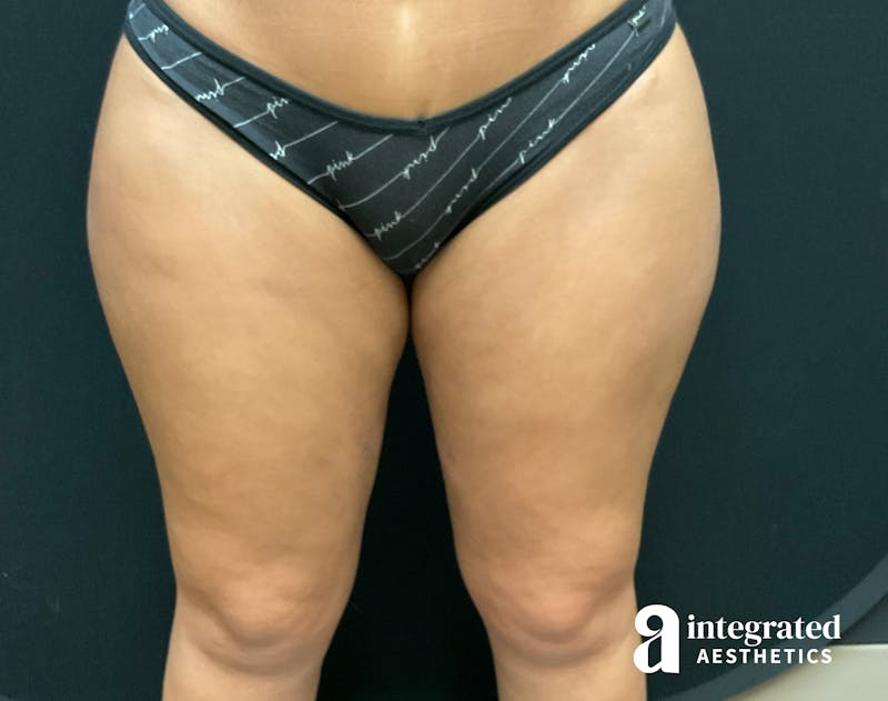 BodyTite Before & After Gallery - Patient 133213710 - Image 6