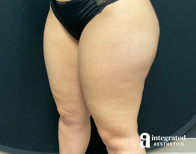 BodyTite Before & After Gallery - Patient 133213710 - Image 1