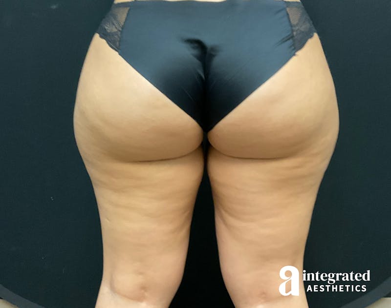 BodyTite Before & After Gallery - Patient 133213710 - Image 3