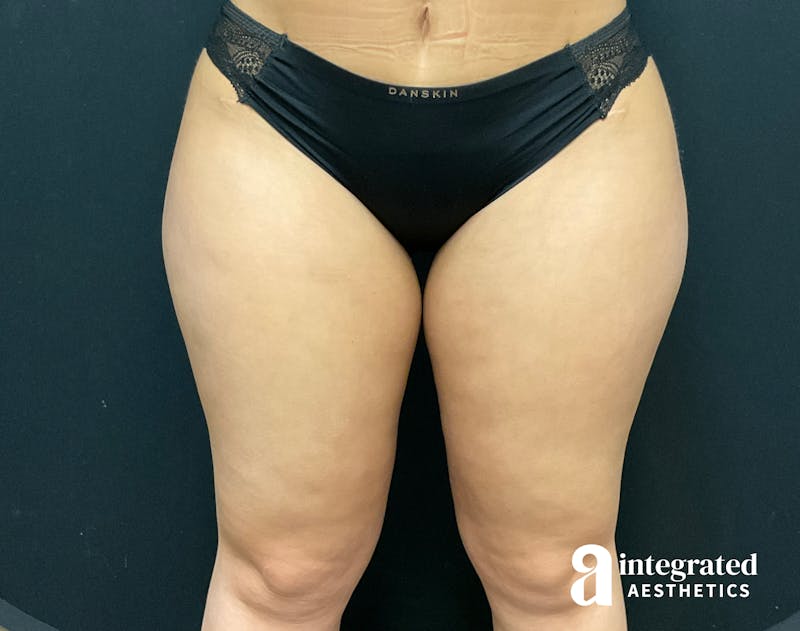 BodyTite Before & After Gallery - Patient 133213710 - Image 5